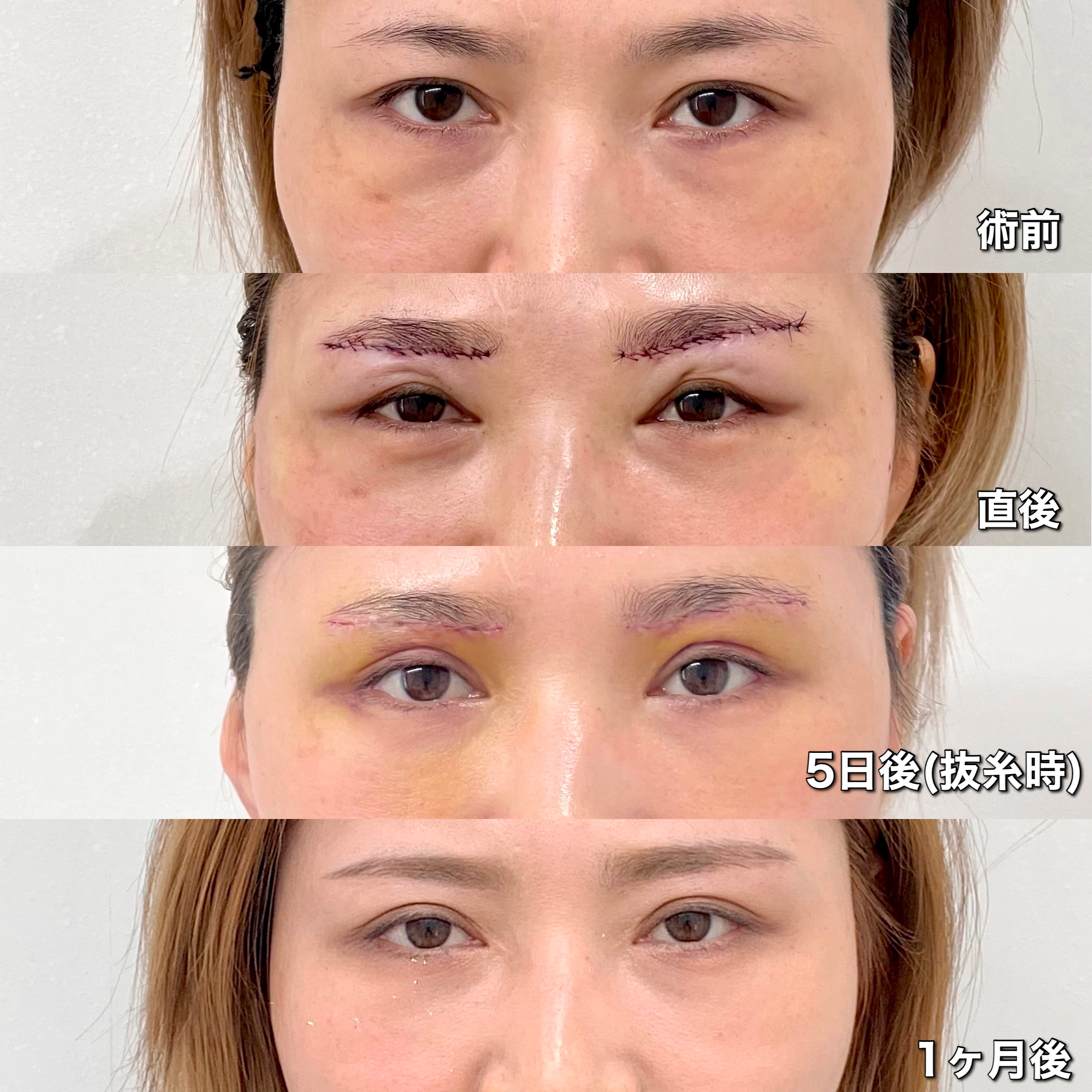 眉下切開術の症例写真