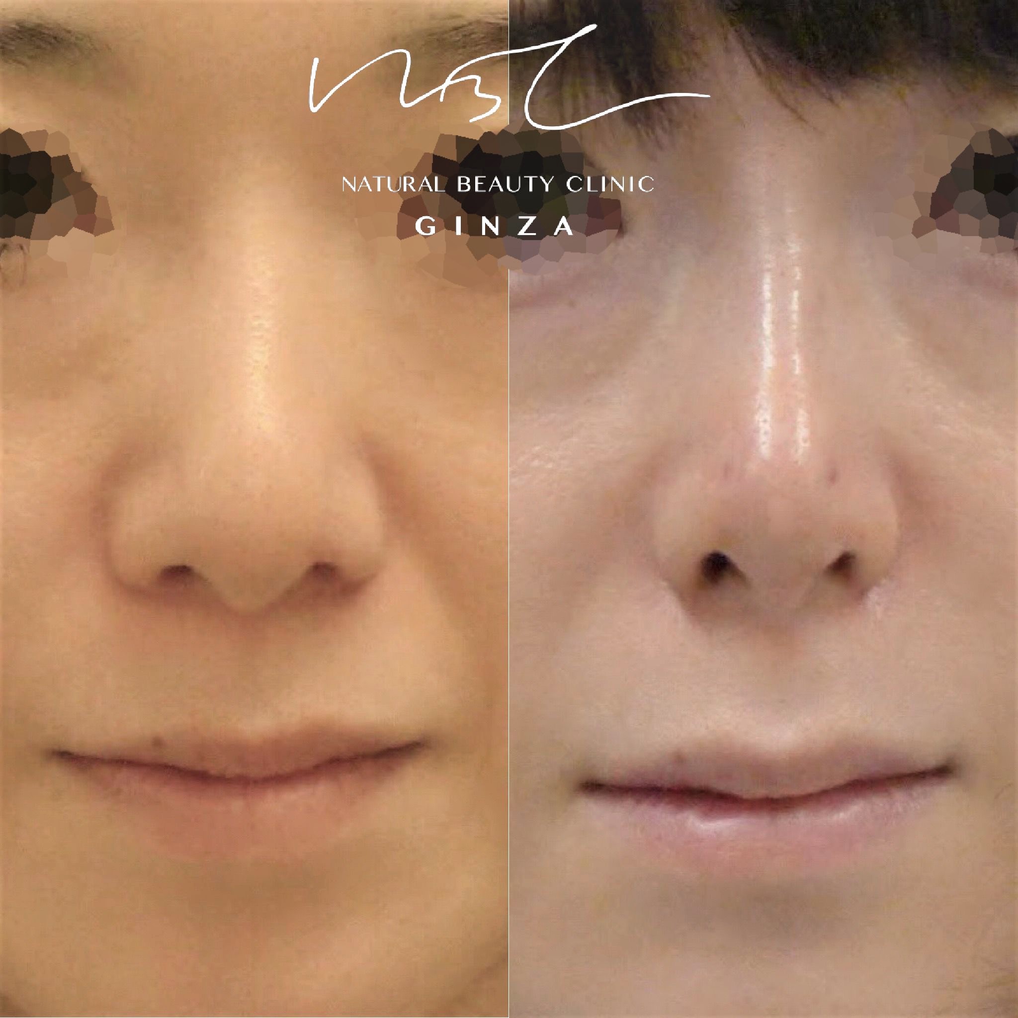 鼻整形 | カテゴリー | 名古屋の美容外科｜Cinderella & Da Vinci Clinic【公式】