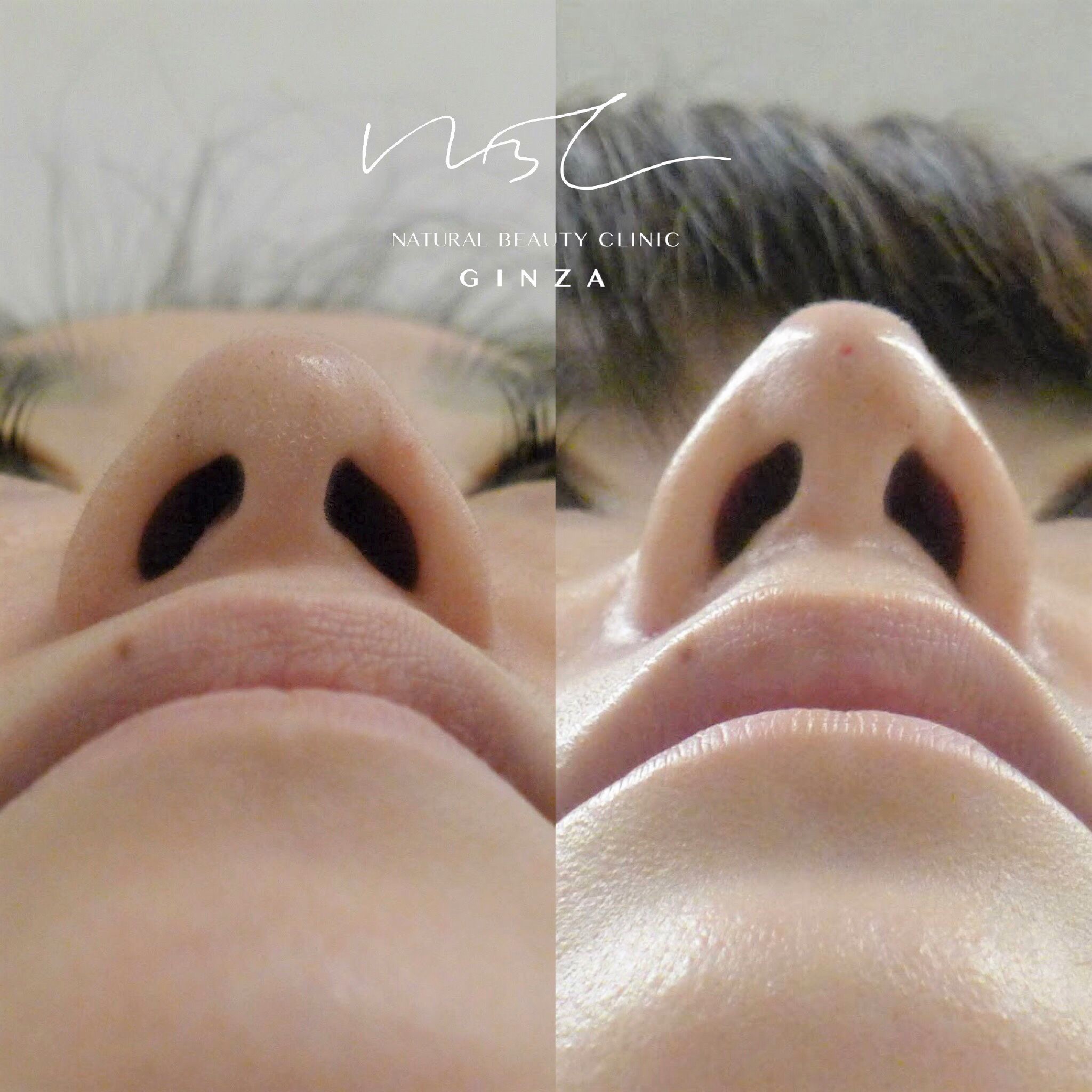 [鼻整形・韓国整形] DA日本人モニターの鼻整形完全レポ！鼻整形VLOG | 韓国DA美容外科【韓国整形・美容整形】
