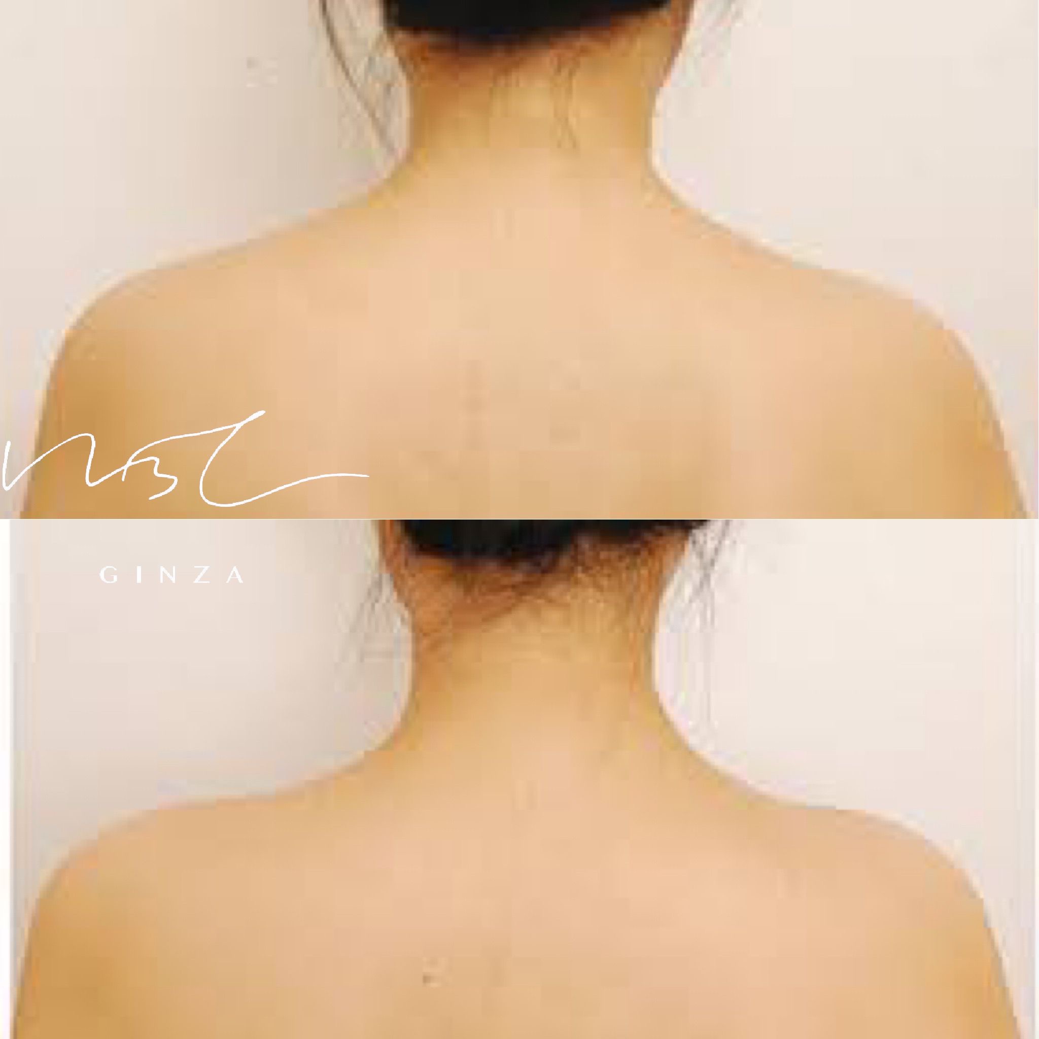 肩ボトックス注射の症例写真