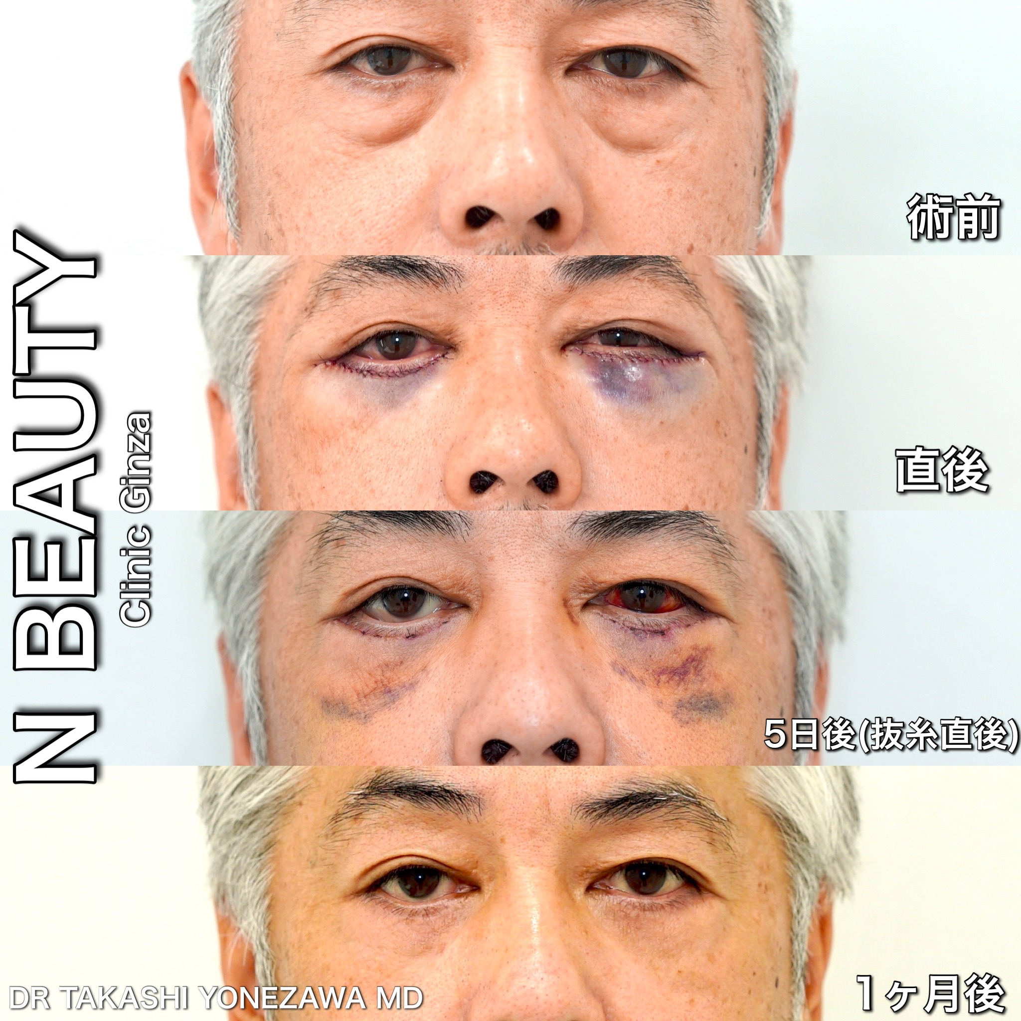 公式 目の下のたるみ取り切開法 下眼瞼切開法 nビューティークリニック銀座